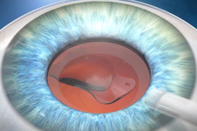 7. Lente intraocular