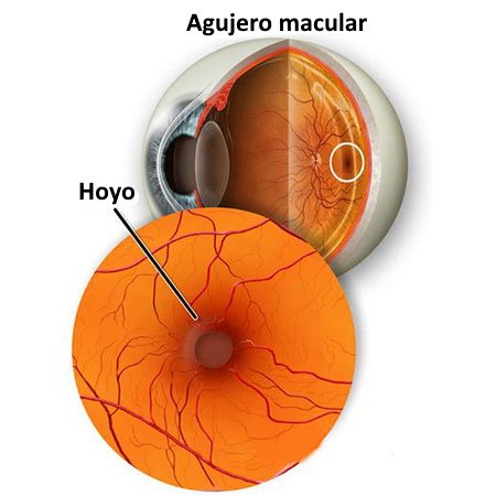 https://oftalmologodelicias.com.mx/wp-content/plugins/phastpress/phast.php/c2VydmljZT1pbWFnZXMmc3JjPWh0dHBzJTNBJTJGJTJGb2Z0YWxtb2xvZ29kZWxpY2lhcy5jb20ubXglMkZ3cC1jb250ZW50JTJGdXBsb2FkcyUyRjIwMjElMkYwMiUyRm1hY3VsYXItaG9sZS5qcGcmY2FjaGVNYXJrZXI9MTY2ODQ1NDAyMS0yOTEwMSZ0b2tlbj02YTNjNzVjMTMxNDczMDVk.q.jpg